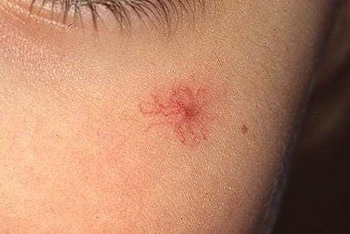 Spider Angioma