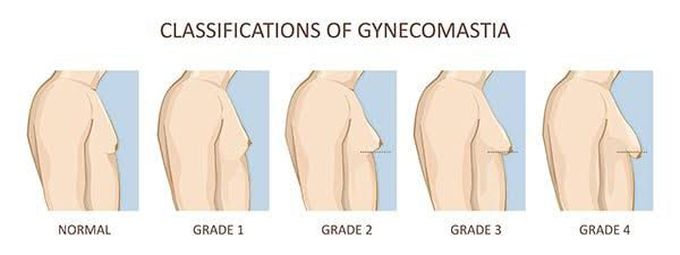 Classification of Gynaecomastia