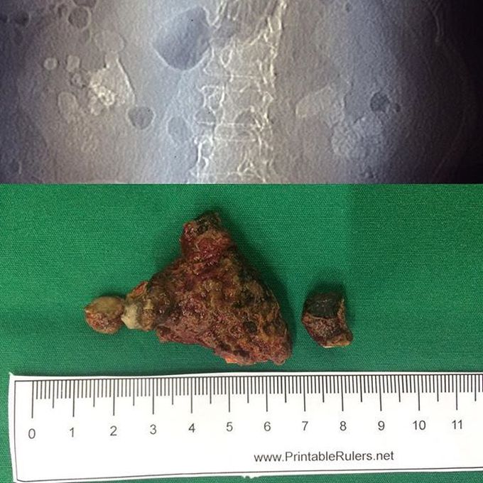 Kidney stone