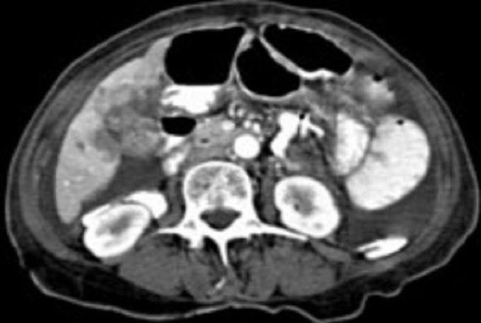 Gallbladder Cancer