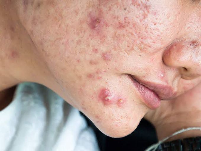 Cystic acne