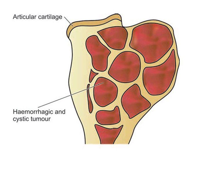 Giant cell tumour