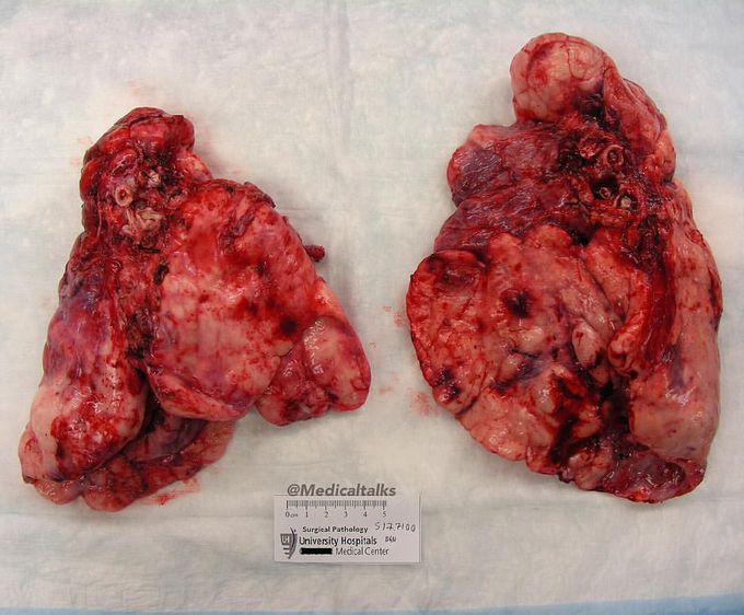 Cystic fibrosis lungs!  
