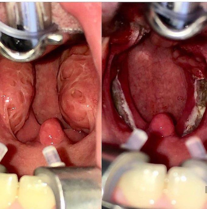 Tosillectomy before and after