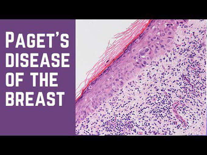 Pagets Disease