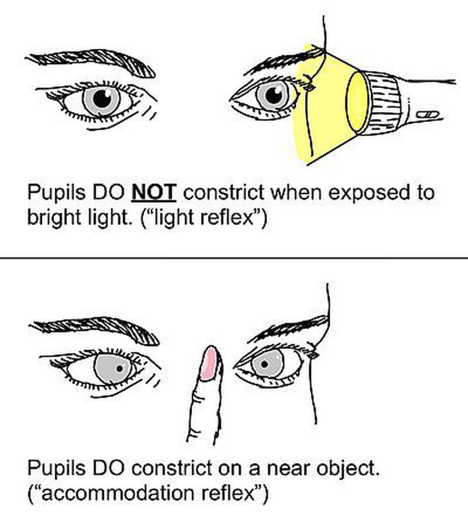 Argyll-Robertson Pupils
