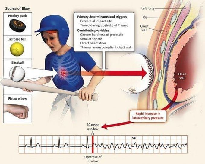 What causes commotio cordis?