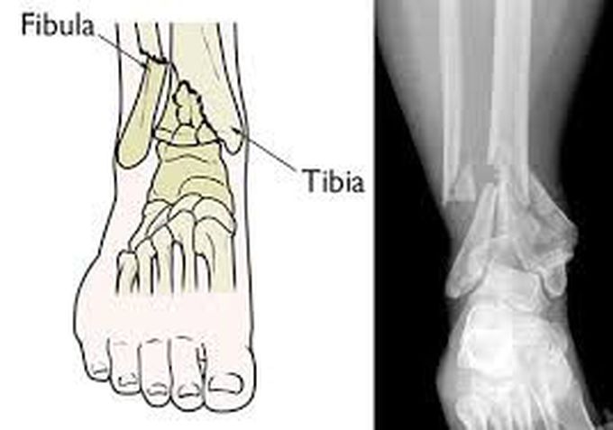 Pilons fracture