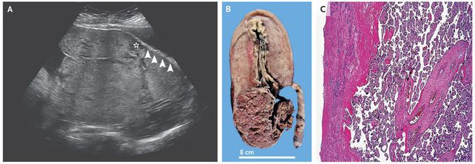 Placenta Increta