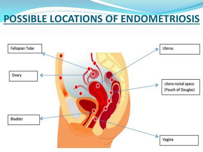 Common Sites of Endometriosis