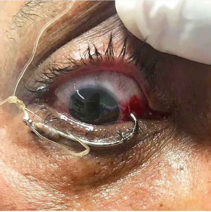 Ocular Fishhook Injury