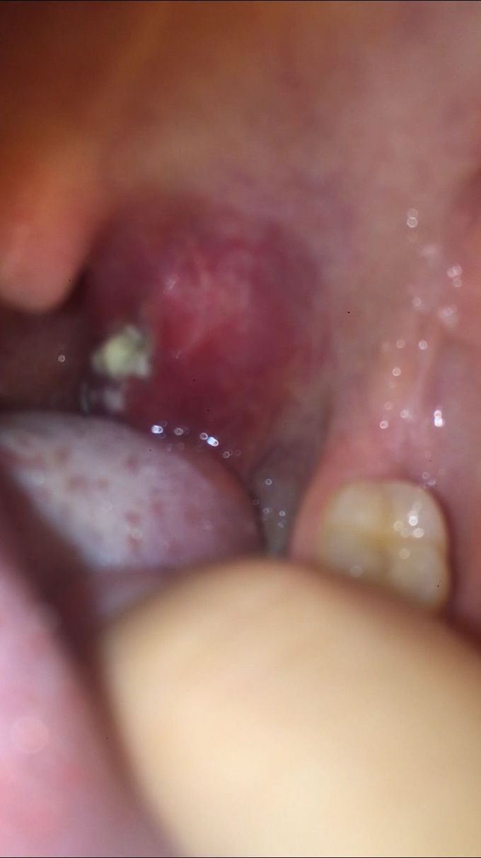 Diagnosis?? Suspicious things on tonsils