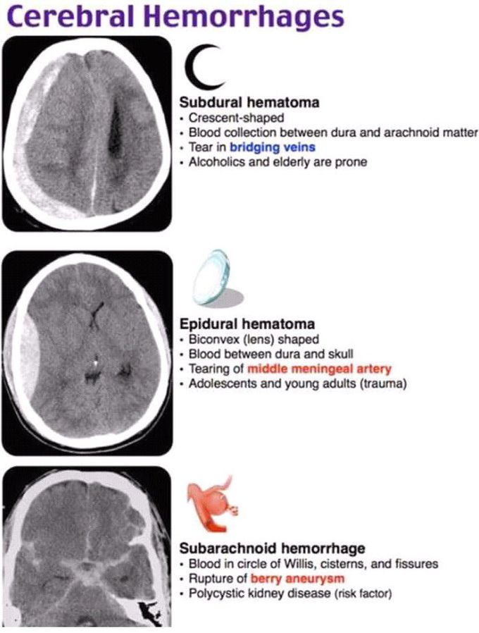 Cerebral hemorrhage