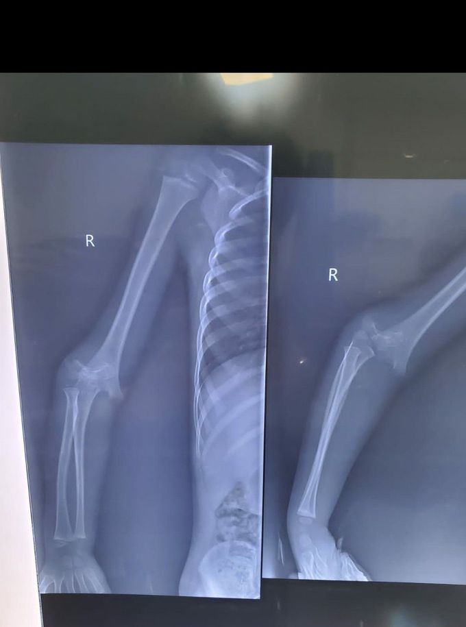 Radius(distal end) dislocation and Ulnar(distal end) fracture with displacement