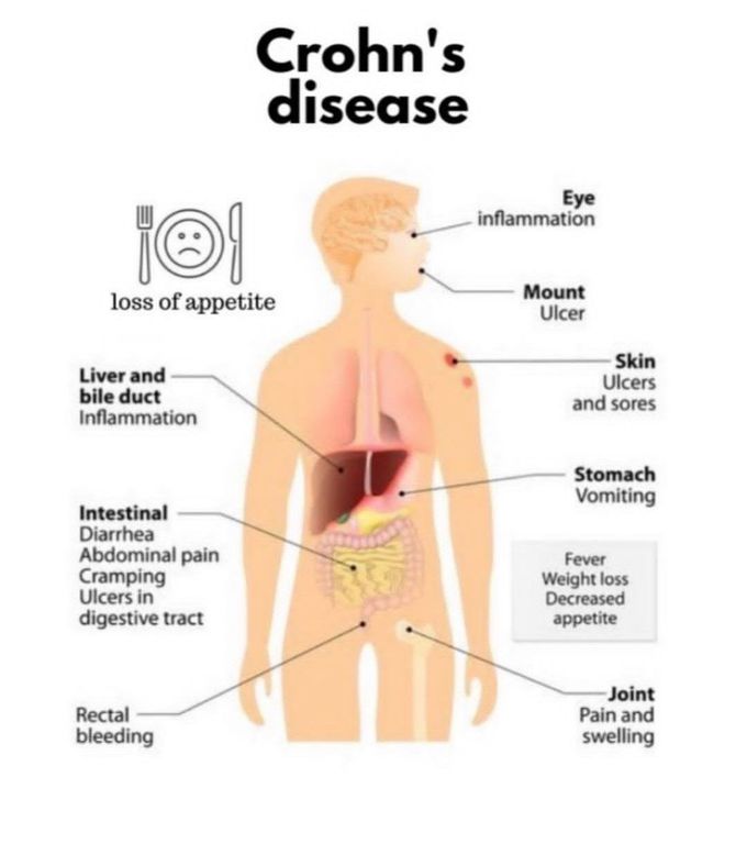 Crohn's Disease