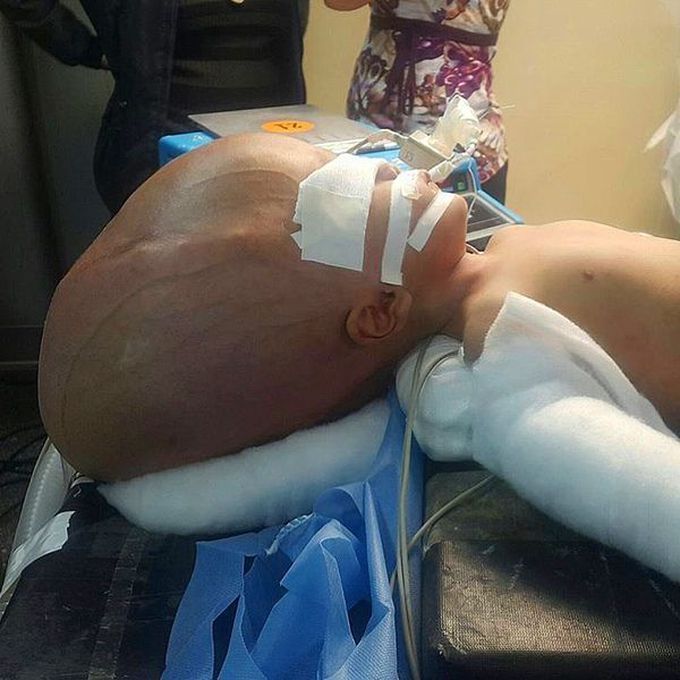 Hydrocephaly