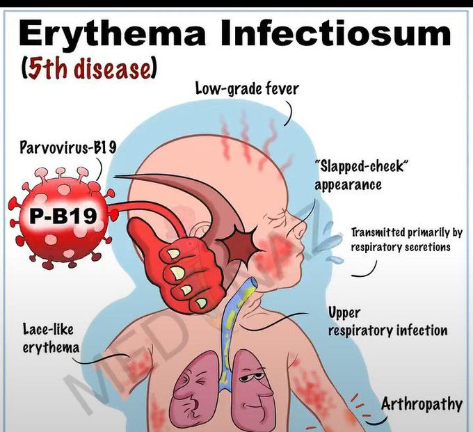 Erythema Infectiosum