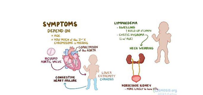 Turner's syndrome