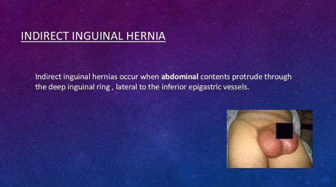 Inguinal hernia type