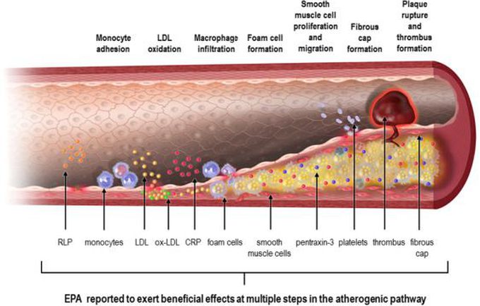 Steps of Atheromatous Plaque Formation