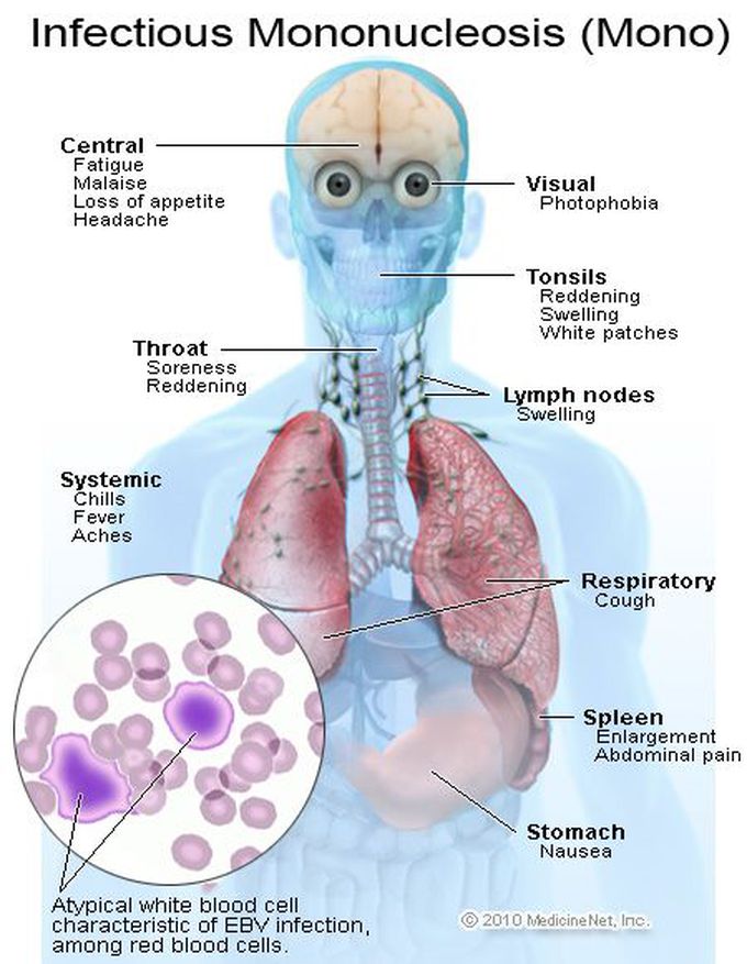 Infectious mononucleosis