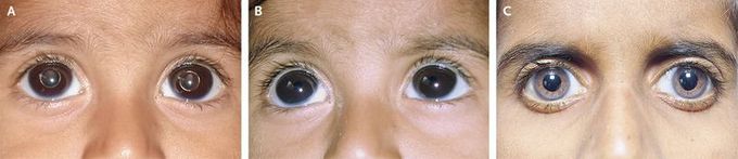 Bilateral Wandering Lens in an Infant