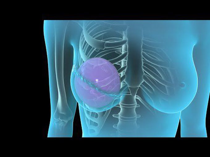 Breast Reconstruction- Made easy