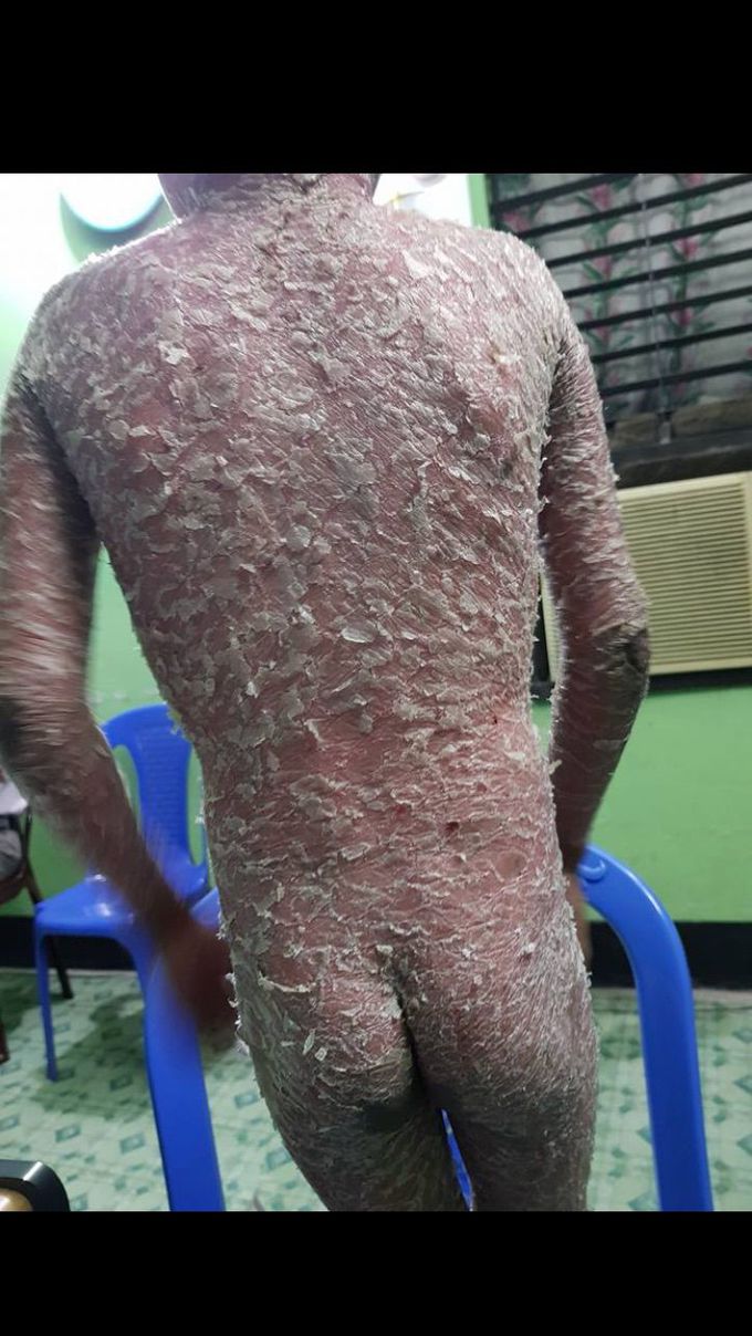 Icthyosis vulgaris