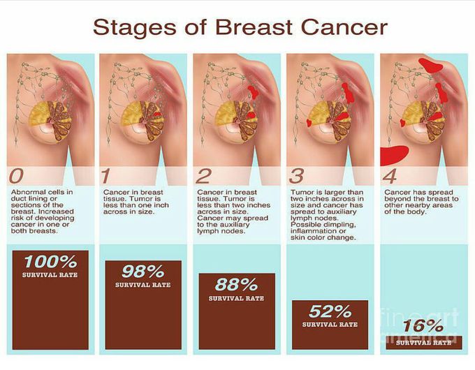Breast Cancer