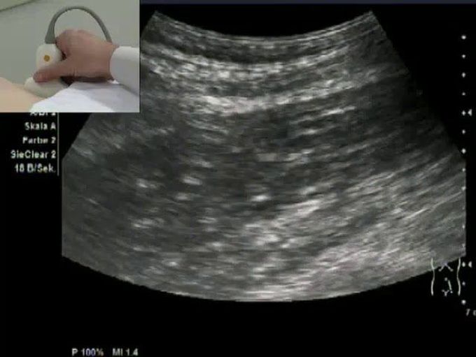 How to scan upper retroperitoneum by ultrasound (longitudinal view )