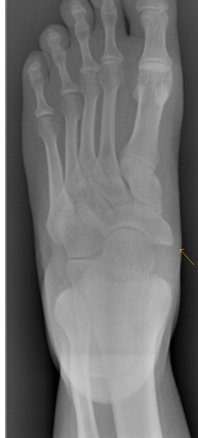 Cornuate Navicular