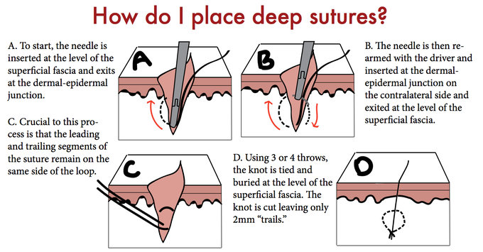 Deep sutures