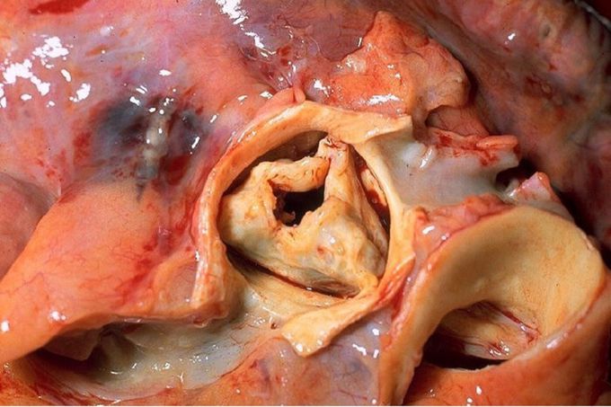 Aortic valve with severe stenosis