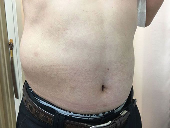 Tingling back and abdominal wall protrusion
