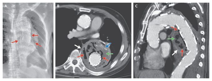 Emphysematous Aortitis after Endovascular Graft