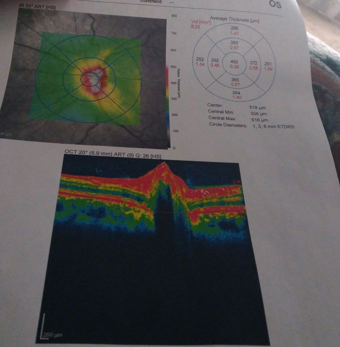 Eye issue, can u guess what the issue is?