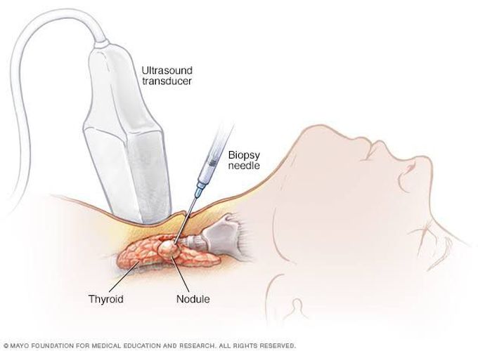 Needle biopsy