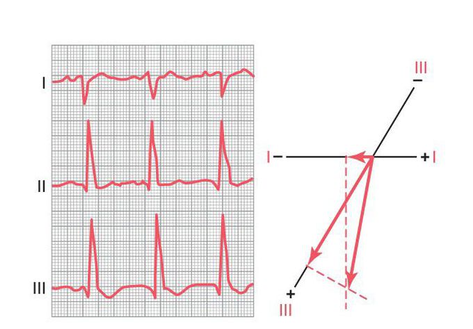 Right bundle branch block