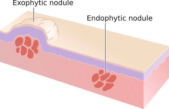 Nodule