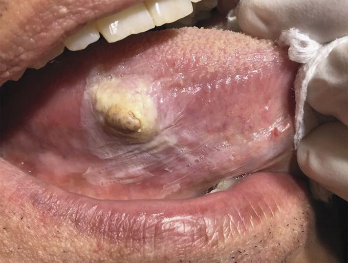 Spindle-Cell Sarcoma of the Tongue
