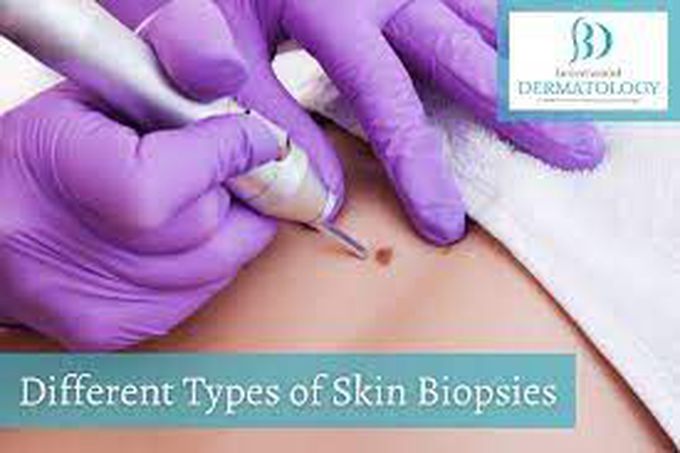 Types of biopsies