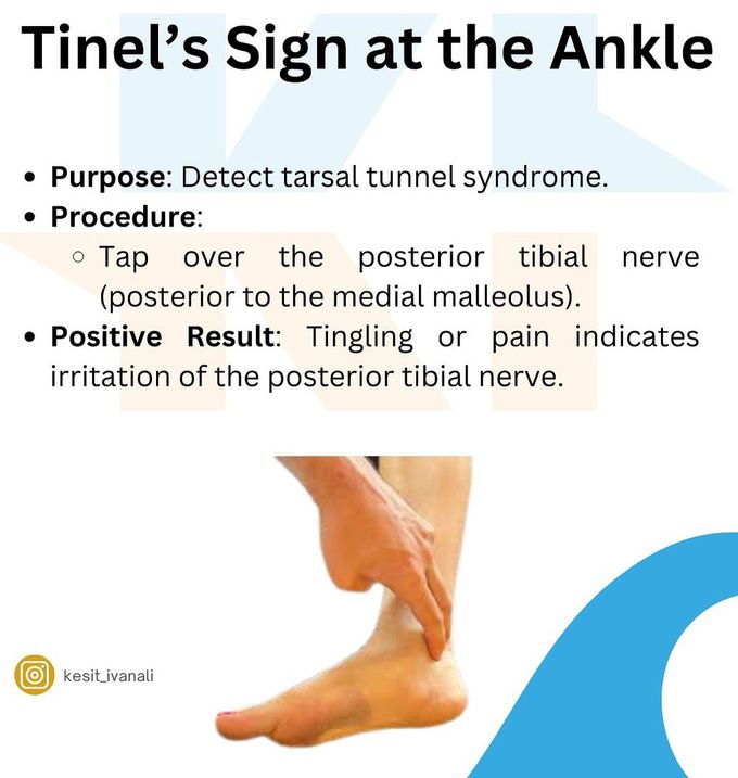 Tinel's Sign at Ankle