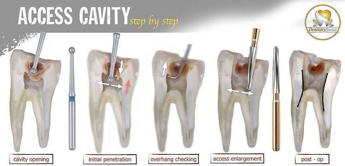 Access Cavity