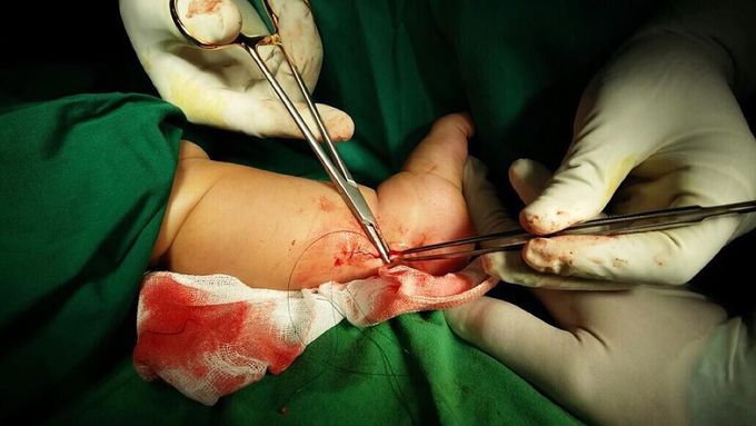 Stitching 
