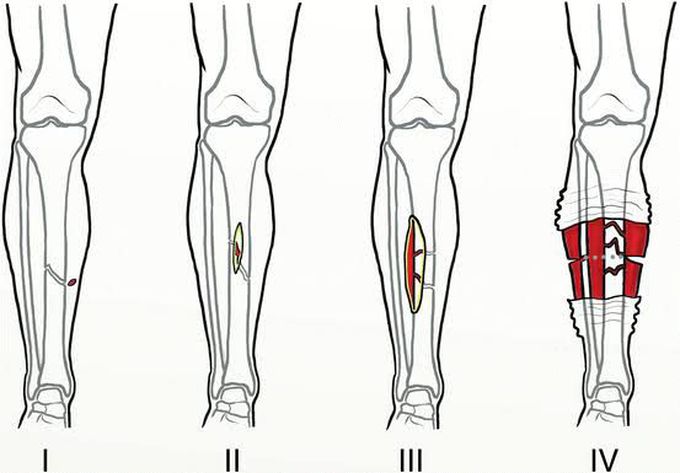 Tscherne Classification of Soft Tissue Injury