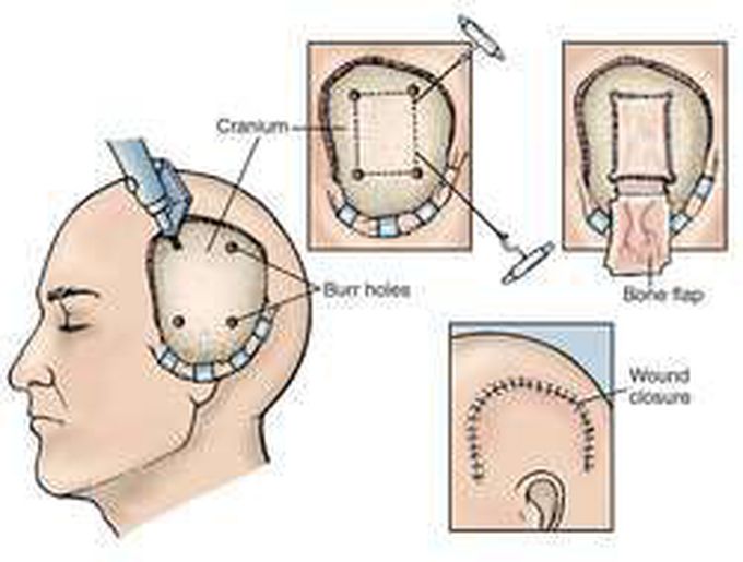 Craniotomy