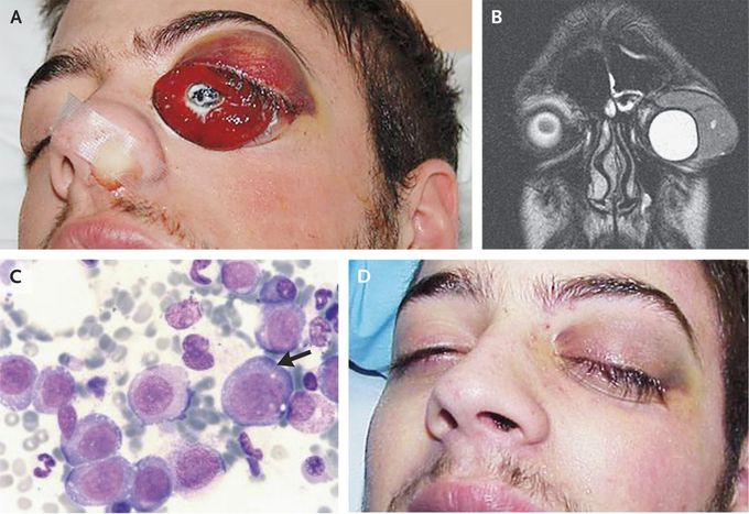 Myeloid Sarcoma
