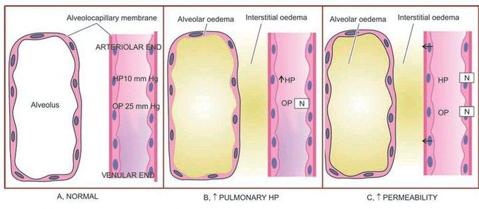 Pulmonary oedema