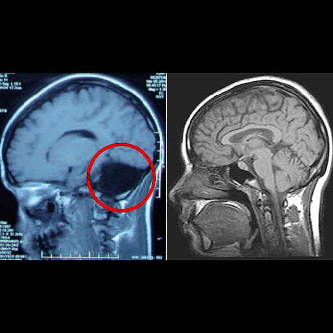 Cerebellar Agenesis