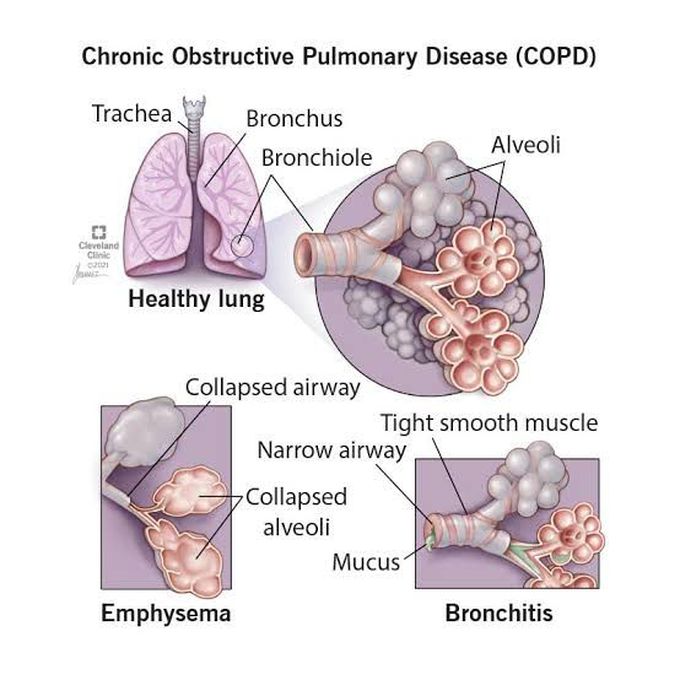 Why Does Copd Happens Medizzy 5104